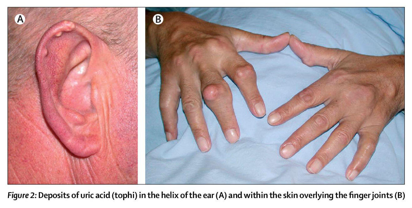 Gout Article: The Lancet, Jan 2010