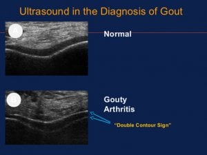 Ultrasound of early chronic gout duration timeline